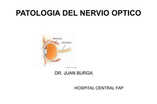 PATOLOGIA DEL NERVIO OPTICO
DR. JUAN BURGA
HOSPITAL CENTRAL FAP
 