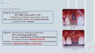 11
Class III - Buccal bone is Lost
IIP+ GBR+ bone grafts + CTG
- Depending on degree compromises of buccal
plate, case alternatively handled with staged approach.
- Indication for IIP is limited.
Class IV - Buccal bone is Severely compromised
- IIP in remaining palatal bone.
- Results in significantly off Axial Implant placement
- So implant should be delayed (Type IV)
If implant is placed immediately, it inclines towards buccal wall &
will result in significant esthetic compromise.
 