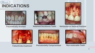 16
INDICATIONS
Traumatically Avulsed Retained Deciduous Teeth Horizontal or Vertical Fracture
Failed Endo-treatment Periodontally Compromised Non-restorable Teeth
 