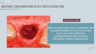25
ANATOMIC CONFIGURATIONS AFTER TOOTH EXTRACTION
After a tooth has been extracted, the
resultant defect in the bone may
have several anatomic
configurations that directly
influence implant placement.
Chen, Wilson et al. 2004
 