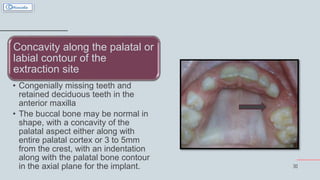 30
Concavity along the palatal or
labial contour of the
extraction site
• Congenially missing teeth and
retained deciduous teeth in the
anterior maxilla
• The buccal bone may be normal in
shape, with a concavity of the
palatal aspect either along with
entire palatal cortex or 3 to 5mm
from the crest, with an indentation
along with the palatal bone contour
in the axial plane for the implant.
 