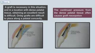 A graft is necessary in this situation,
and in a location with dense palatal
tissue, obtaining an excellent result
is difficult. Onlay grafts are difficult
to place along a palatal concavity.
The continued pressure from
the dense palatal tissue often
causes graft resorpotion
 