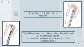 42
2 mm Round drill with copious
irrigation
The drill tip should be positioned along the palatal wall
of the extraction socket,
3 mm to 5 mm coronal to the apical end of the
extraction socket
 