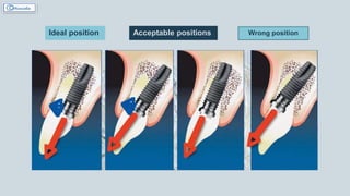 Ideal position Acceptable positions Wrong position
 