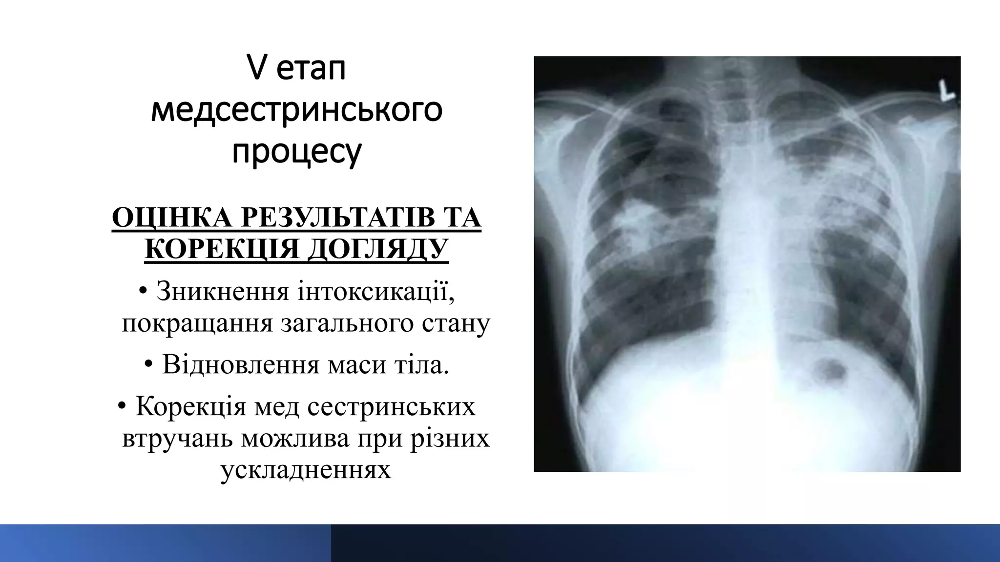 V етап
медсестринського
процесу
ОЦІНКА РЕЗУЛЬТАТІВ ТА
КОРЕКЦІЯ ДОГЛЯДУ
• Зникнення інтоксикації,
покращання загального стану
• Відновлення маси тіла.
• Корекція мед сестринських
втручань можлива при різних
ускладненнях
 