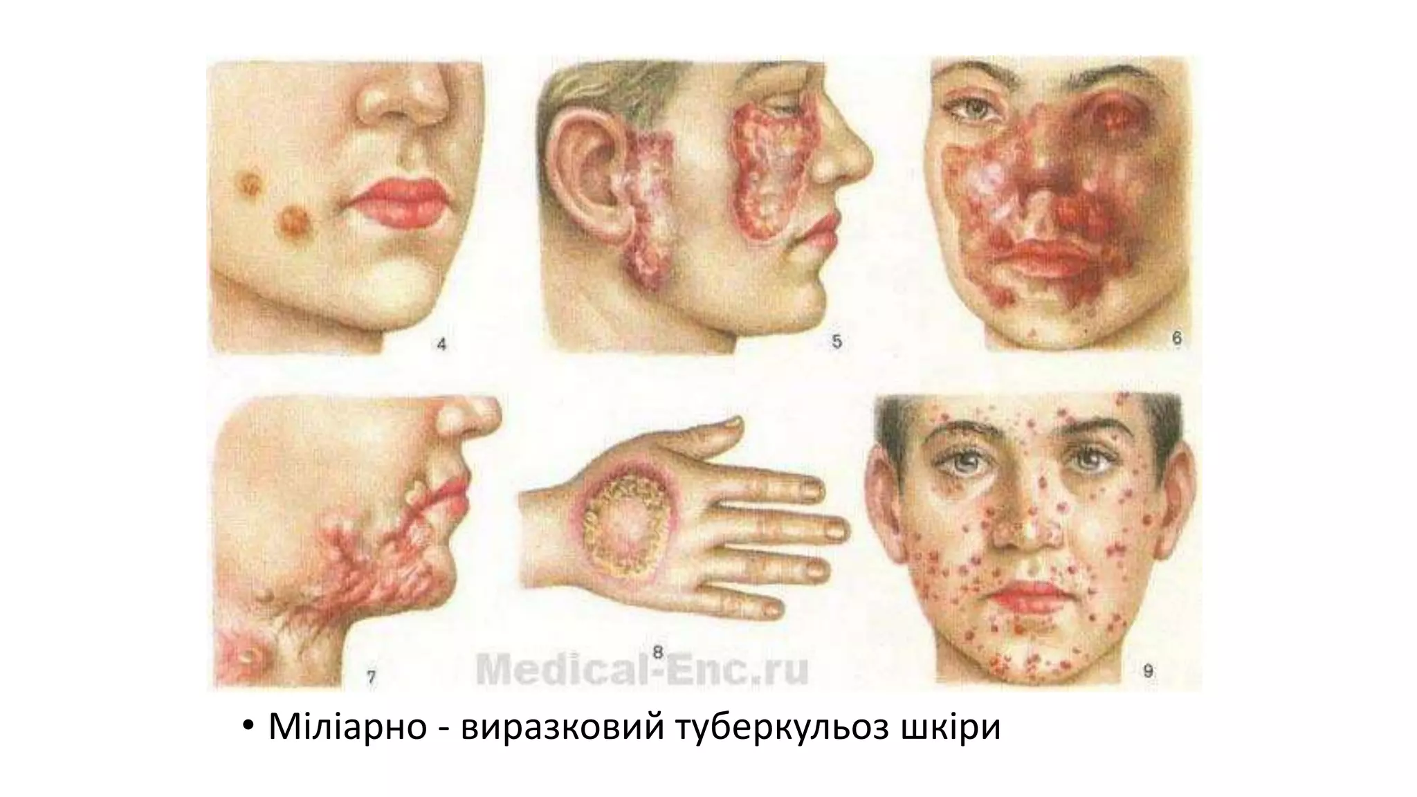 • Міліарно - виразковий туберкульоз шкіри
 