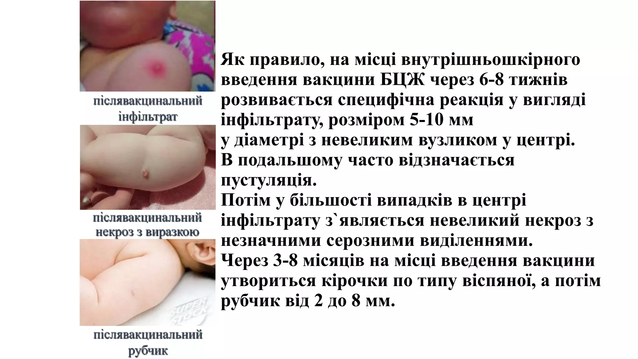 Як правило, на місці внутрішньошкірного
введення вакцини БЦЖ через 6-8 тижнів
розвивається специфічна реакція у вигляді
інфільтрату, розміром 5-10 мм
у діаметрі з невеликим вузликом у центрі.
В подальшому часто відзначається
пустуляція.
Потім у більшості випадків в центрі
інфільтрату з`являється невеликий некроз з
незначними серозними виділеннями.
Через 3-8 місяців на місці введення вакцини
утвориться кірочки по типу віспяної, а потім
рубчик від 2 до 8 мм.
післявакцинальний
інфільтрат
післявакцинальний
некроз з виразкою
післявакцинальний
рубчик
 
