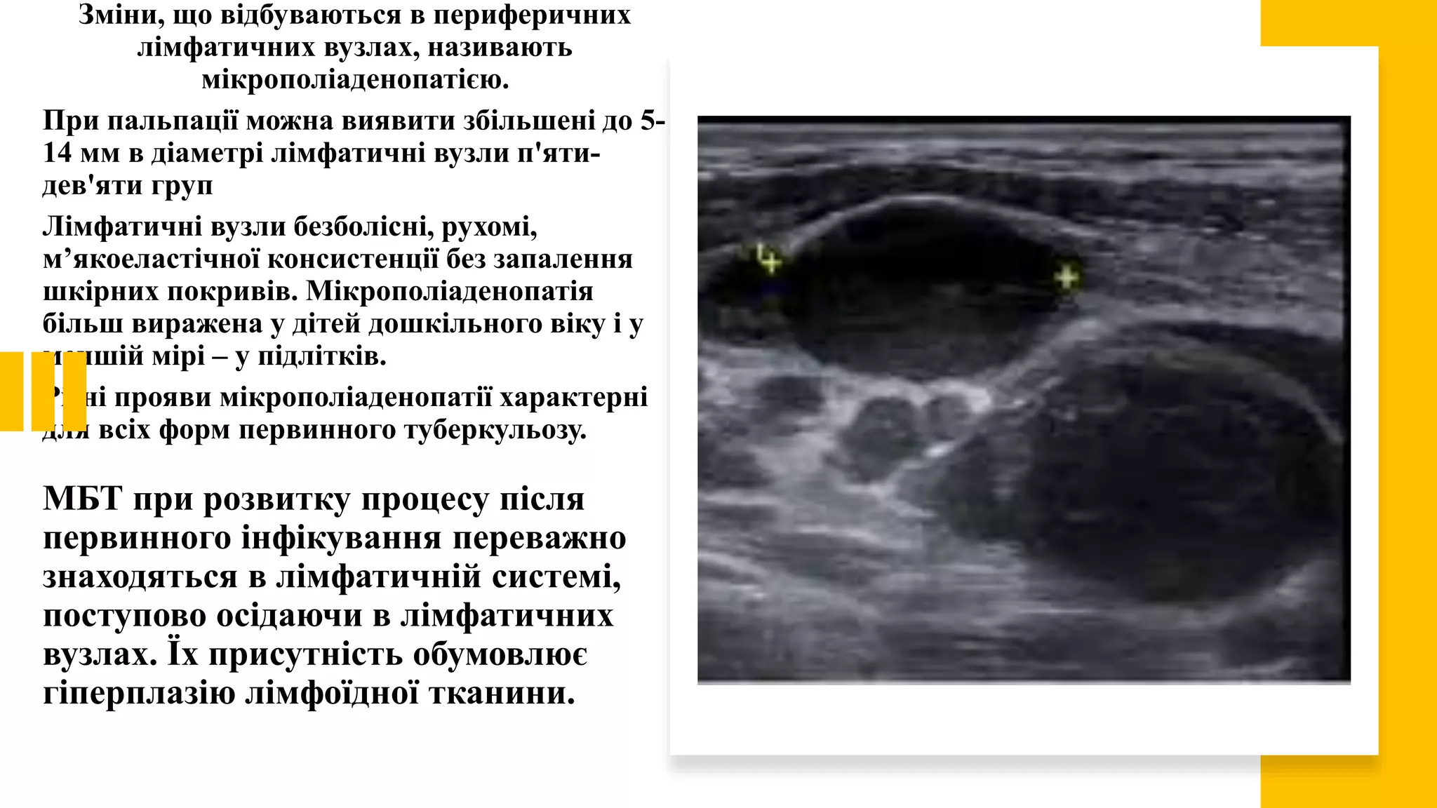 МБТ при розвитку процесу після
первинного інфікування переважно
знаходяться в лімфатичній системі,
поступово осідаючи в лімфатичних
вузлах. Їх присутність обумовлює
гіперплазію лімфоїдної тканини.
Зміни, що відбуваються в периферичних
лімфатичних вузлах, називають
мікрополіаденопатією.
При пальпації можна виявити збільшені до 5-
14 мм в діаметрі лімфатичні вузли п'яти-
дев'яти груп
Лімфатичні вузли безболісні, рухомі,
м’якоеластічної консистенції без запалення
шкірних покривів. Мікрополіаденопатія
більш виражена у дітей дошкільного віку і у
меншій мірі – у підлітків.
Різні прояви мікрополіаденопатії характерні
для всіх форм первинного туберкульозу.
 