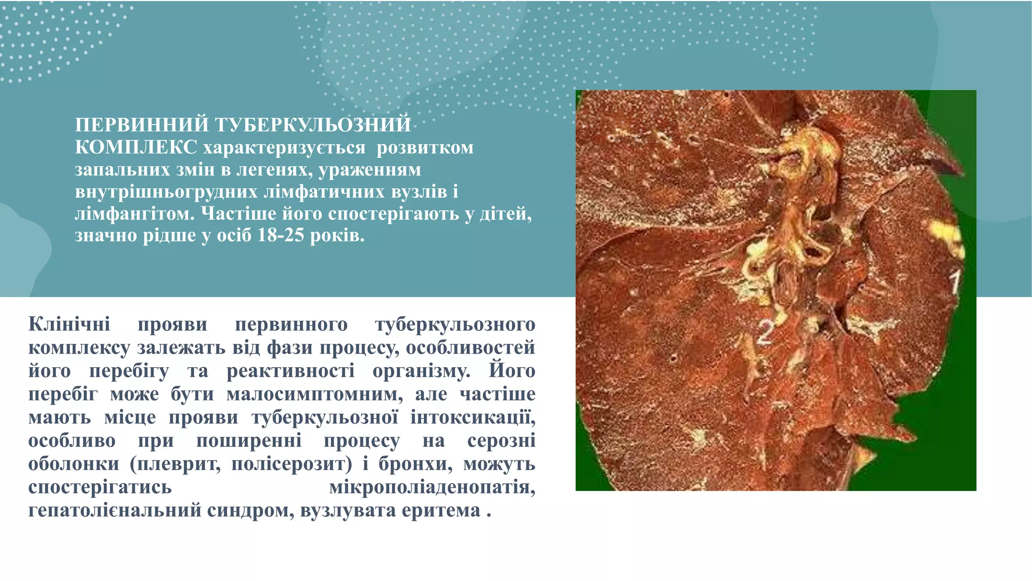 ПЕРВИННИЙ ТУБЕРКУЛЬОЗНИЙ
КОМПЛЕКС характеризується розвитком
запальних змін в легенях, ураженням
внутрішньогрудних лімфатичних вузлів і
лімфангітом. Частіше його спостерігають у дітей,
значно рідше у осіб 18-25 років.
Клінічні прояви первинного туберкульозного
комплексу залежать від фази процесу, особливостей
його перебігу та реактивності організму. Його
перебіг може бути малосимптомним, але частіше
мають місце прояви туберкульозної інтоксикації,
особливо при поширенні процесу на серозні
оболонки (плеврит, полісерозит) і бронхи, можуть
спостерігатись мікрополіаденопатія,
гепатолієнальний синдром, вузлувата еритема .
 