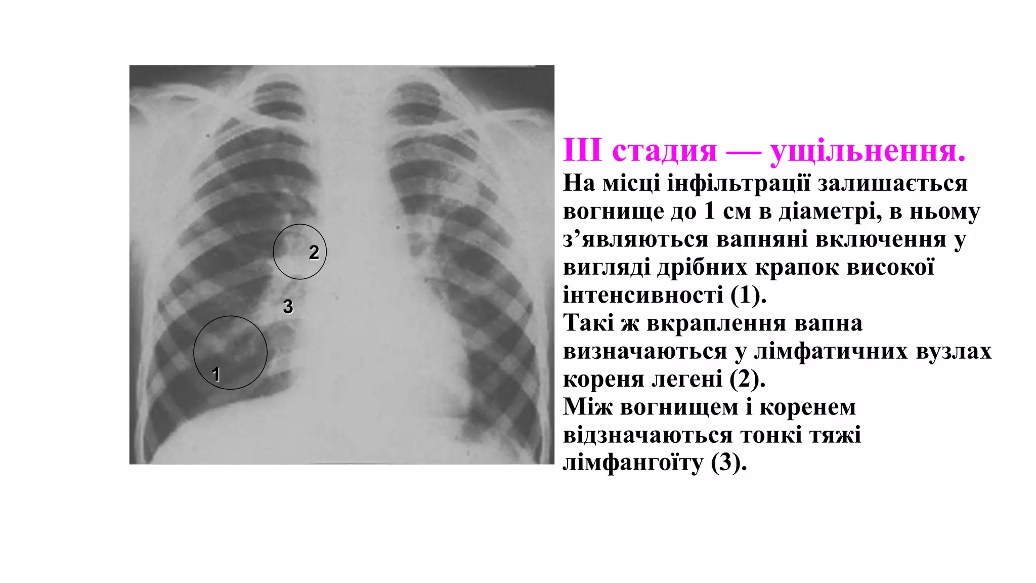 III стадия — ущільнення.
На місці інфільтрації залишається
вогнище до 1 см в діаметрі, в ньому
з’являються вапняні включення у
вигляді дрібних крапок високої
інтенсивності (1).
Такі ж вкраплення вапна
визначаються у лімфатичних вузлах
кореня легені (2).
Між вогнищем і коренем
відзначаються тонкі тяжі
лімфангоїту (3).
1
2
3
 