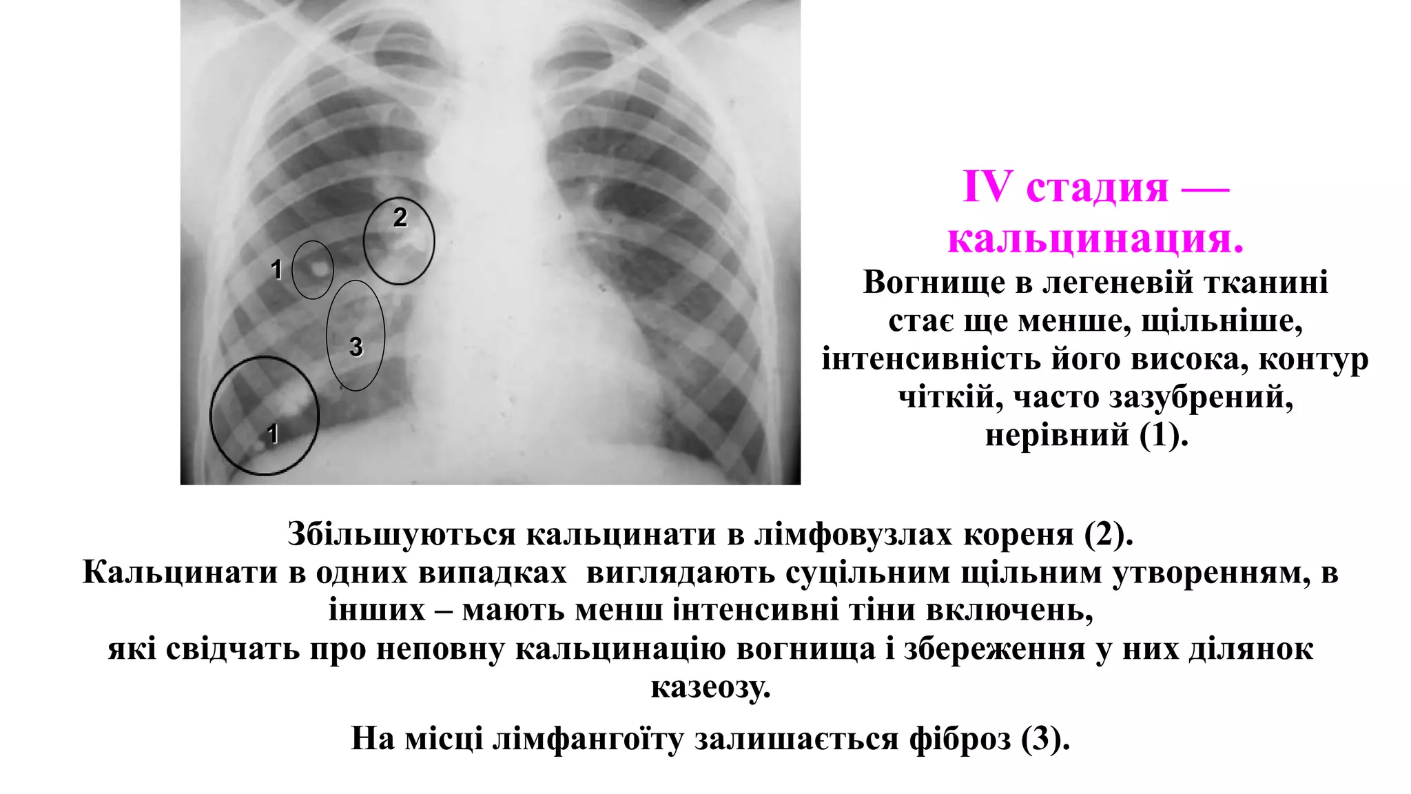 IV стадия —
кальцинация.
Вогнище в легеневій тканині
стає ще менше, щільніше,
інтенсивність його висока, контур
чіткій, часто зазубрений,
нерівний (1).
Збільшуються кальцинати в лімфовузлах кореня (2).
Кальцинати в одних випадках виглядають суцільним щільним утворенням, в
інших – мають менш інтенсивні тіни включень,
які свідчать про неповну кальцинацію вогнища і збереження у них ділянок
казеозу.
На місці лімфангоїту залишається фіброз (3).
1
2
1
3
 