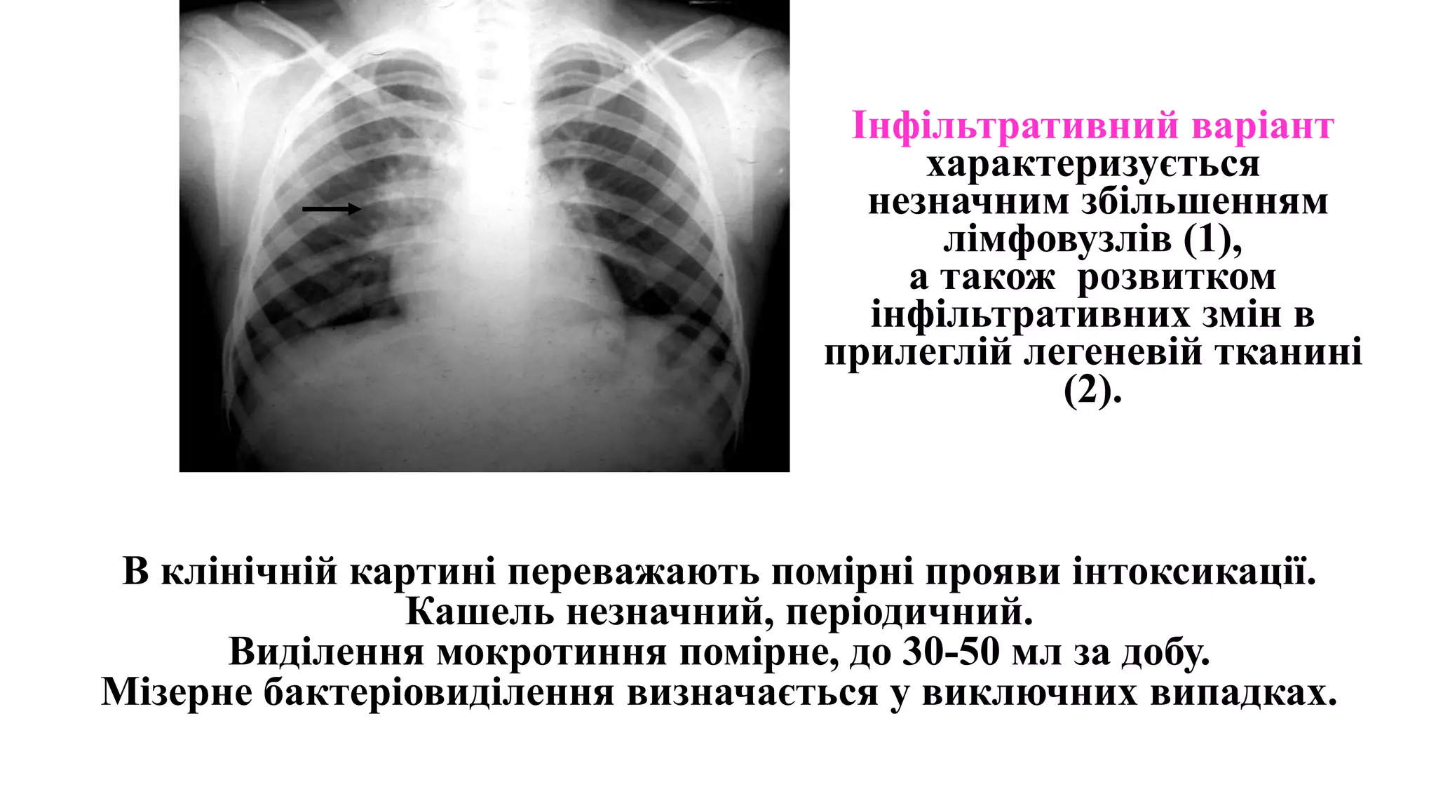 Інфільтративний варіант
характеризується
незначним збільшенням
лімфовузлів (1),
а також розвитком
інфільтративних змін в
прилеглій легеневій тканині
(2).
В клінічній картині переважають помірні прояви інтоксикації.
Кашель незначний, періодичний.
Виділення мокротиння помірне, до 30-50 мл за добу.
Мізерне бактеріовиділення визначається у виключних випадках.
 