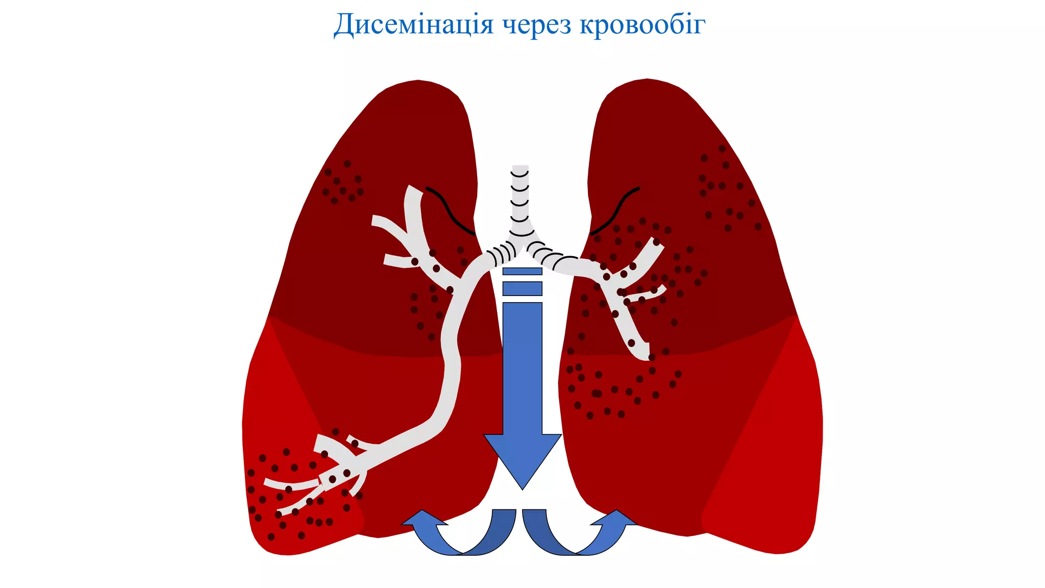Дисемінація через кровообіг
 