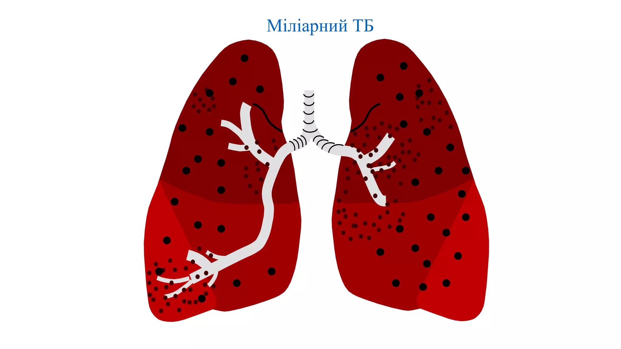 Міліарний ТБ
 