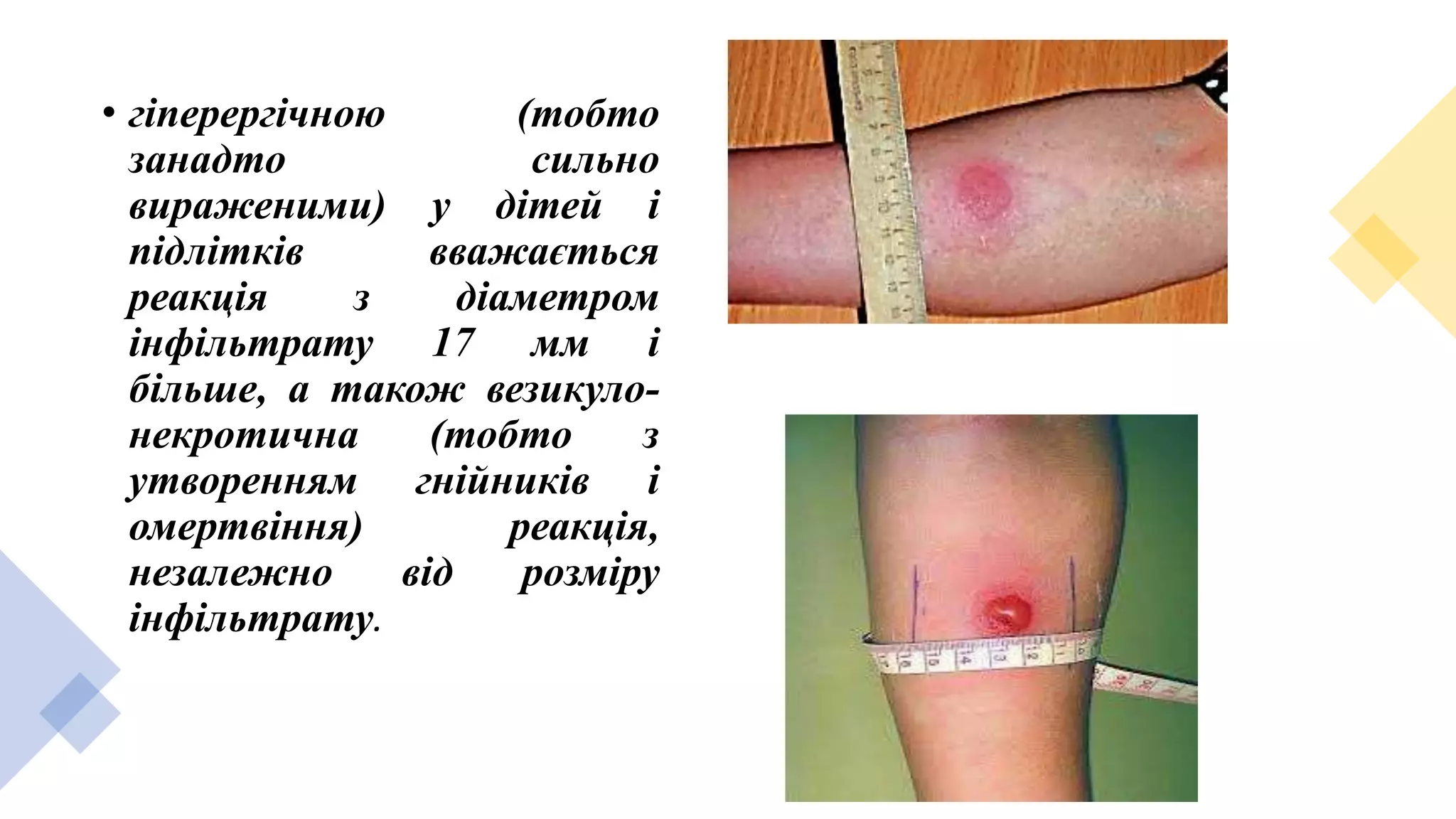 • гіперергічною (тобто
занадто сильно
вираженими) у дітей і
підлітків вважається
реакція з діаметром
інфільтрату 17 мм і
більше, а також везикуло-
некротична (тобто з
утворенням гнійників і
омертвіння) реакція,
незалежно від розміру
інфільтрату.
 