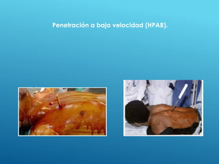 Penetración a baja velocidad (HPAB).
 