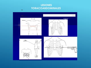tórax
Region
toracoabdominal
Abdomen
Diaphragm
LESIONES
TORACOABDOMINALES.
Thoracoabdominal
Region
 