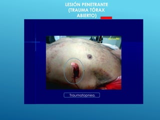 Traumatopnea.
LESIÓN PENETRANTE
(TRAUMA TÓRAX
ABIERTO)
 