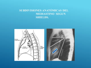 SUBDIVISIONES ANATÓMICAS DEL
MEDIASTINO SEGUN
SHIELDS.
 