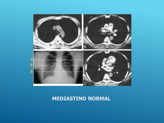 MEDIASTINO NORMAL
 