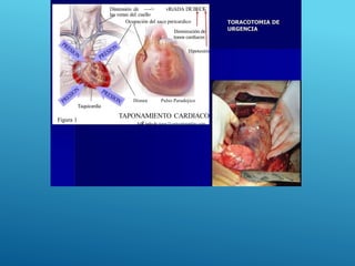 Figura l
Taquicardia
Distensión de —-> vRíADA DEBECK
las venas del cuello
Ocupación del saco pericardico
Disminución de
tonos cardiacos
Hipotesión
Disnea Pulso Paradojico
TAPONAMIENTO CARDIACO
Ada tado de www.l1cartccnteronlinc.com
 