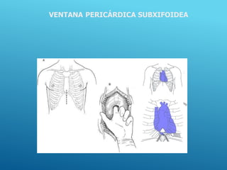 VENTANA PERICÁRDICA SUBXIFOIDEA
 