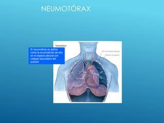NEUMOTÓRAX
El neumotórax se define
como la acumulación de aire
en el espacio pleural con
colapso secundario del
pulmón
 