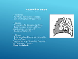 Neumotórax simple
 Incidencia
– 10-30% de los Traumas cerrados.
– casi en el 100 % del TT penetrante
 Causas
– Fractura costal desgarra el pulmón
– Espontáneo en jóvenes asténicos
tras ejercicio, tos, viaje avión
– Síndrome Marfan, TB.
 Clínica:
– Dolor pleurítico, Disnea, tos, Hemoptisis.
– Examen Físico:
Ausencia del M.V.- Timpánico, Ausencia
de Vibraciones Vocales.
(triada de Galliard)
 