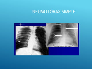 NEUMOTÓRAX SIMPLE
Pleural edge
 