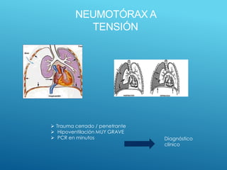NEUMOTÓRAX A
TENSIÓN
 Trauma cerrado / penetrante
 Hipoventilación MUY GRAVE
 PCR en minutos Diagnóstico
clínico
 