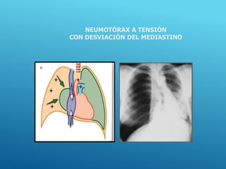 NEUMOTÓRAX A TENSIÓN
CON DESVIACIÓN DEL MEDIASTINO
 