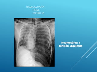 RADIOGRAFÍA
POST-
MORTEM
Neumotórax a
tensión Izquierdo
 