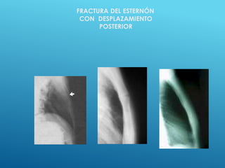 FRACTURA DEL ESTERNÓN
CON DESPLAZAMIENTO
POSTERIOR
 