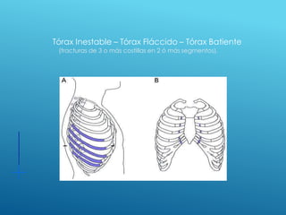Tórax Inestable – Tórax Fláccido – Tórax Batiente
(fracturas de 3 o más costillas en 2 ó más segmentos).
 