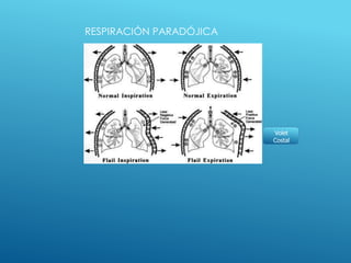RESPIRACIÓN PARADÓJICA
Volet
Costal
 