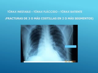 TÓRAX INESTABLE – TÓRAX FLÁCCIDO – TÓRAX BATIENTE
(FRACTURAS DE 3 O MÁS COSTILLAS EN 2 O MÁS SEGMENTOS)
 
