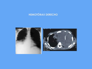HEMOTÓRAX DERECHO
 