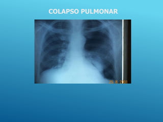 COLAPSO PULMONAR
 