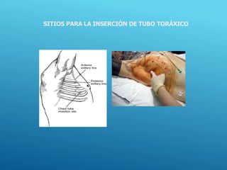 SITIOS PARA LA INSERCIÓN DE TUBO TORÁXICO
 