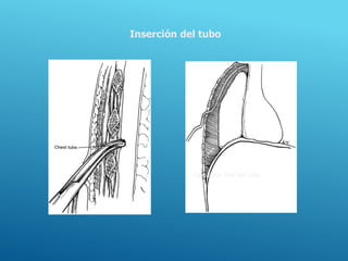 Inserción del tubo
Colocación final del tubo.
 