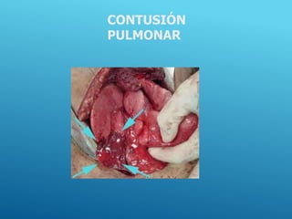 CONTUSIÓN
PULMONAR
 
