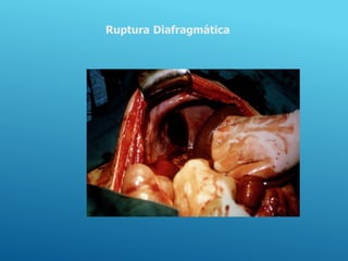 Ruptura Diafragmática
 