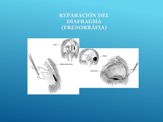 REPARACIÓN DEL
DIAFRAGMA
(FRENORRÁFIA)
 