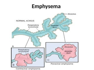 Emphysema
 
