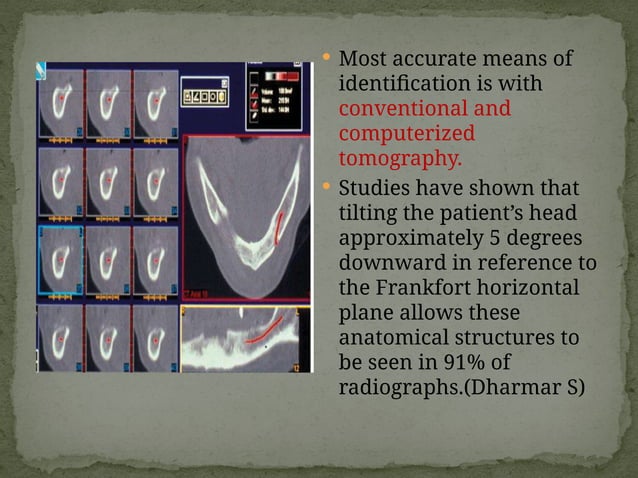 13.Radiographic imaging in implant dentistry.pptx