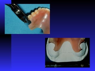 Interiem Rpd nature and usage of Interim Removable Partial Dentures | PPT