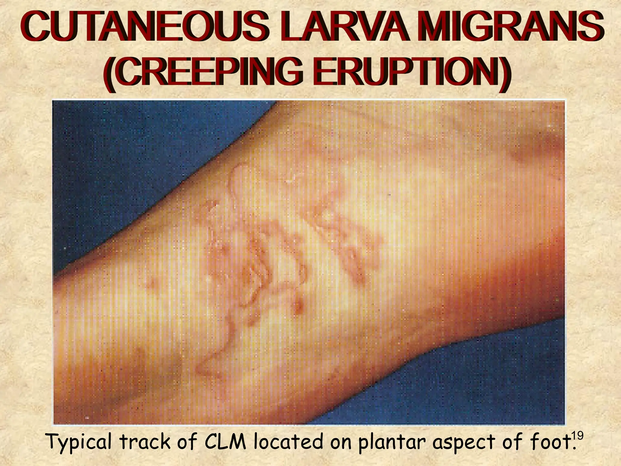 19
Typical track of CLM located on plantar aspect of foot.
 