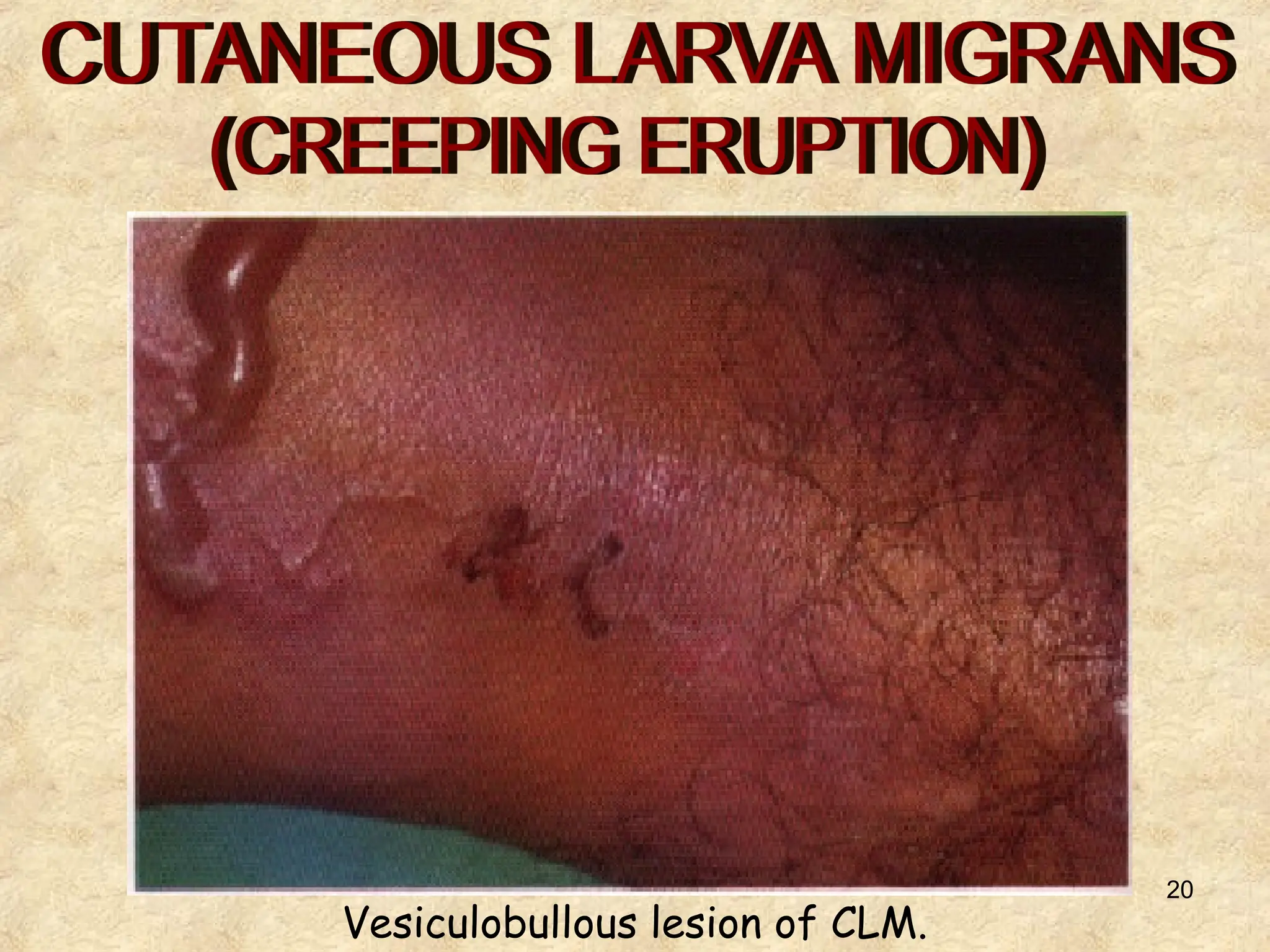 20
Vesiculobullous lesion of CLM.
 