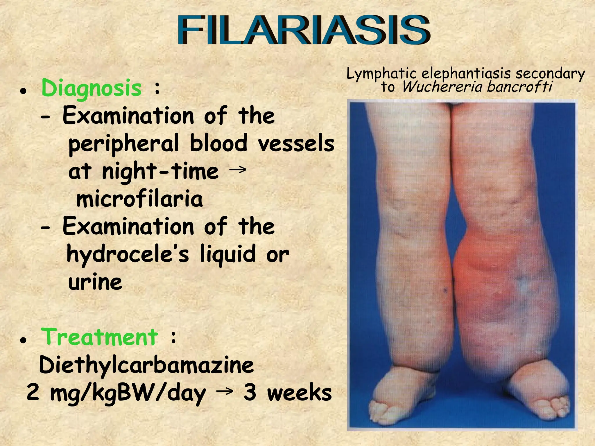 27
● Diagnosis :
- Examination of the
peripheral blood vessels
at night-time →
microfilaria
- Examination of the
hydrocele’s liquid or
urine
● Treatment :
Diethylcarbamazine
2 mg/kgBW/day 3 weeks
→
Lymphatic elephantiasis secondary
to Wuchereria bancrofti
 