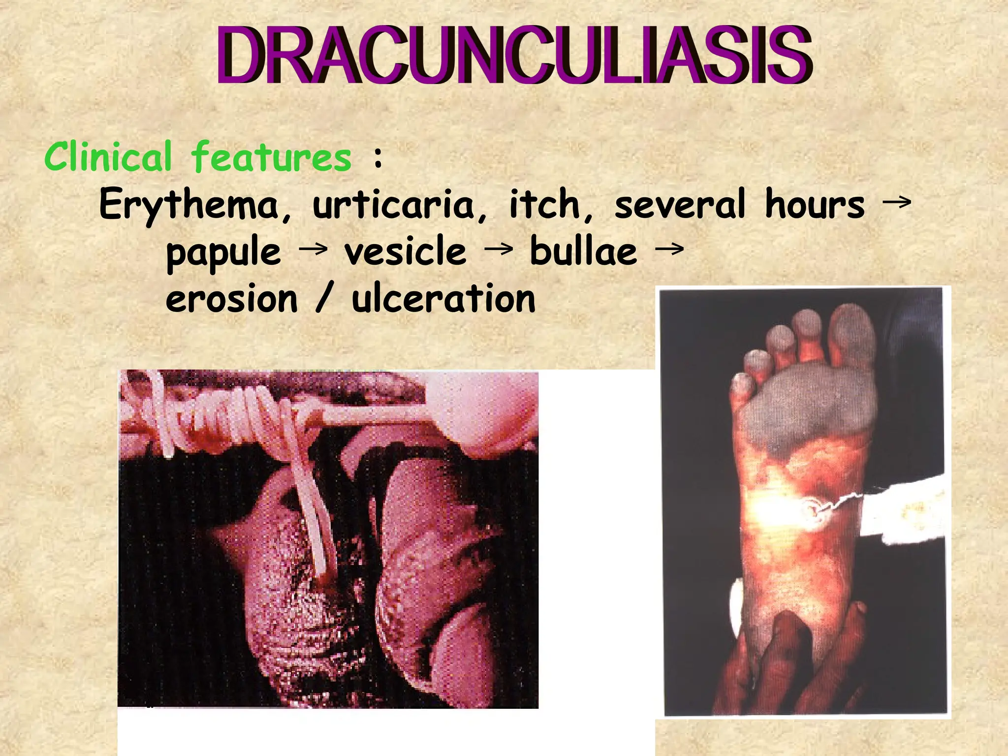 29
Clinical features :
Erythema, urticaria, itch, several hours →
papule vesicle bullae
→ → →
erosion / ulceration
 